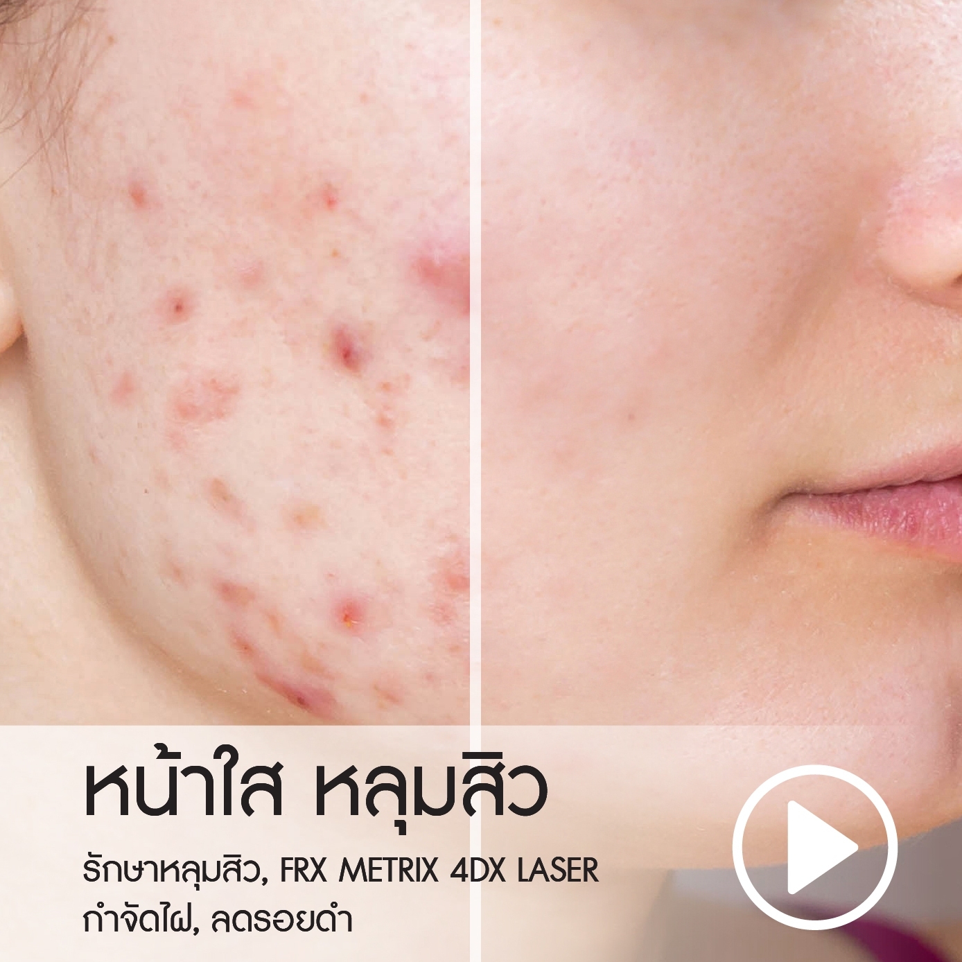 หน้าใส หลุมสิว